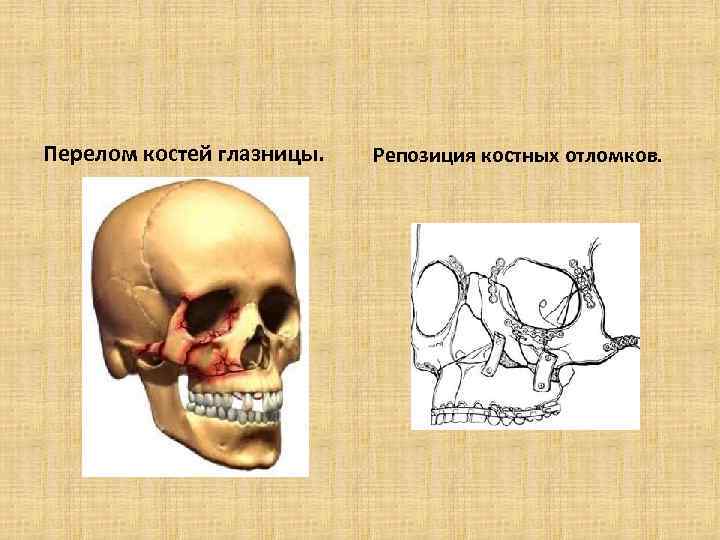 Перелом костей глазницы. Репозиция костных отломков. 