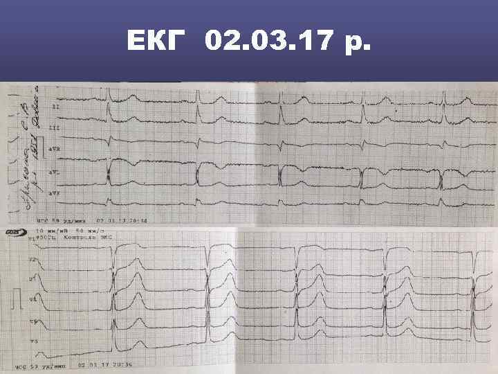 ЕКГ 02. 03. 17 р. 