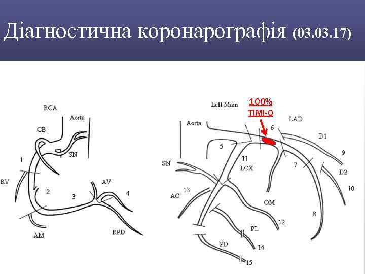 Діагностична коронарографія (03. 17) 100% TIMI-0 