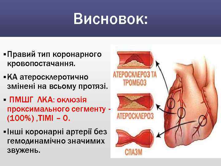 Висновок: § Правий тип коронарного кровопостачання. § КА атеросклеротично змінені на всьому протязі. §