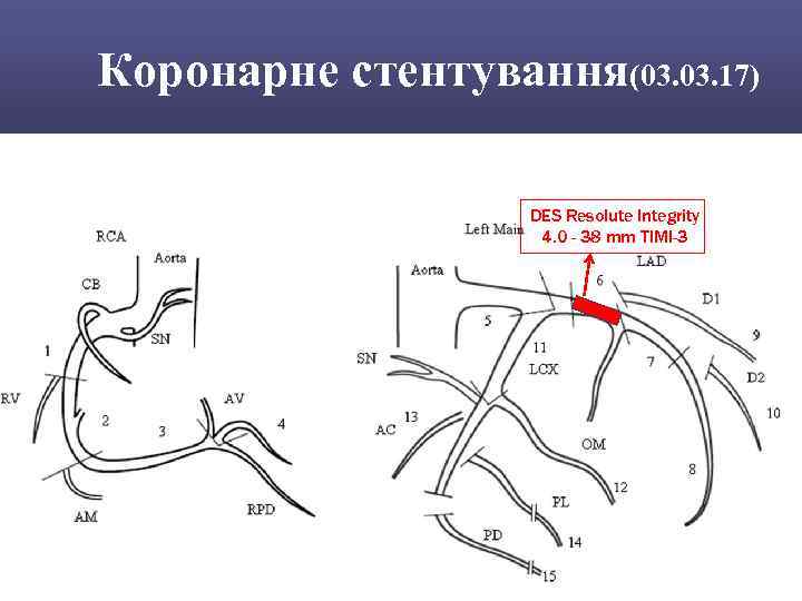 Коронарне стентування(03. 17) DES Resolute Integrity 4. 0 - 38 mm TIMI-3 