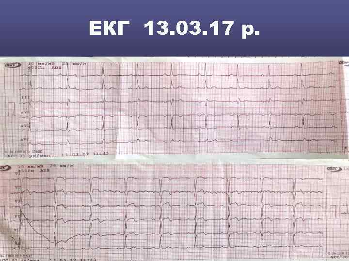 ЕКГ 13. 03. 17 р. 