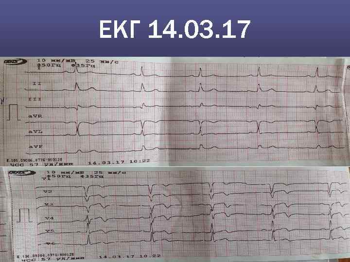 EКГ 14. 03. 17 