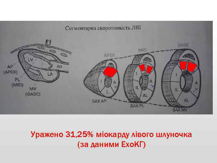 Уражено 31, 25% міокарду лівого шлуночка (за даними Ехо. КГ) 