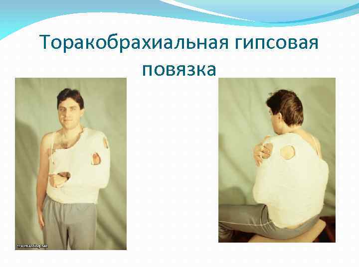 Торакобрахиальная гипсовая повязка 