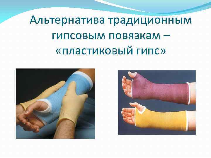 Альтернатива традиционным гипсовым повязкам – «пластиковый гипс» 