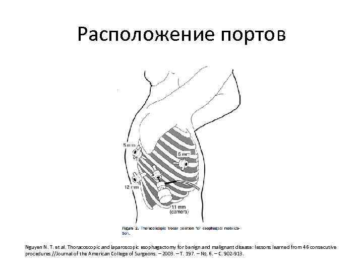 Расположение портов Nguyen N. T. et al. Thoracoscopic and laparoscopic esophagectomy for benign and