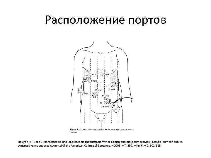 Расположение портов Nguyen N. T. et al. Thoracoscopic and laparoscopic esophagectomy for benign and