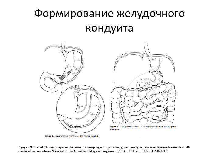 Формирование желудочного кондуита Nguyen N. T. et al. Thoracoscopic and laparoscopic esophagectomy for benign