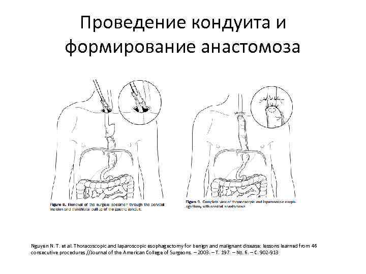 Проведение кондуита и формирование анастомоза Nguyen N. T. et al. Thoracoscopic and laparoscopic esophagectomy