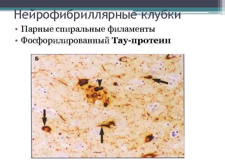 Нейрофибриллярные клубки • Парные спиральные филаменты • Фосфорилированный Тау-протеин 