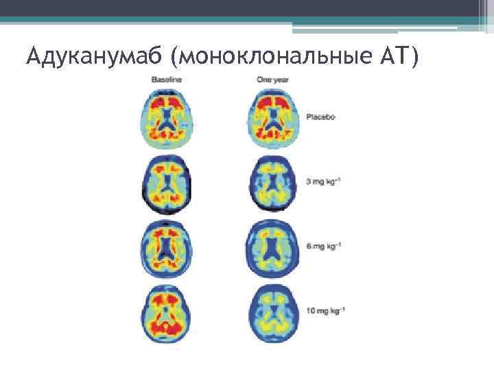 Адуканумаб (моноклональные АТ) 