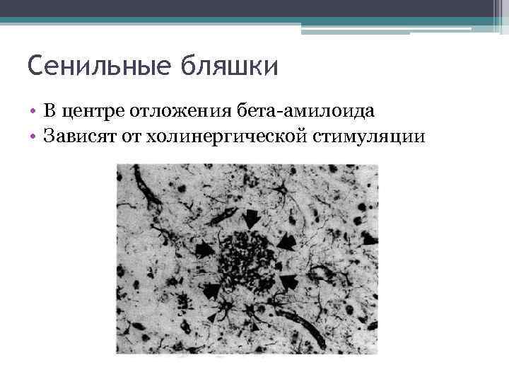 Сенильные бляшки • В центре отложения бета-амилоида • Зависят от холинергической стимуляции 