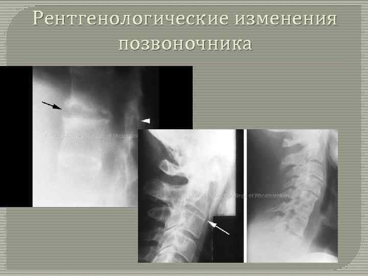 Рентгенологические изменения позвоночника 