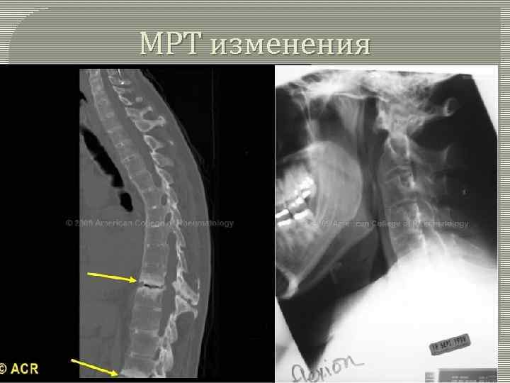 МРТ изменения 