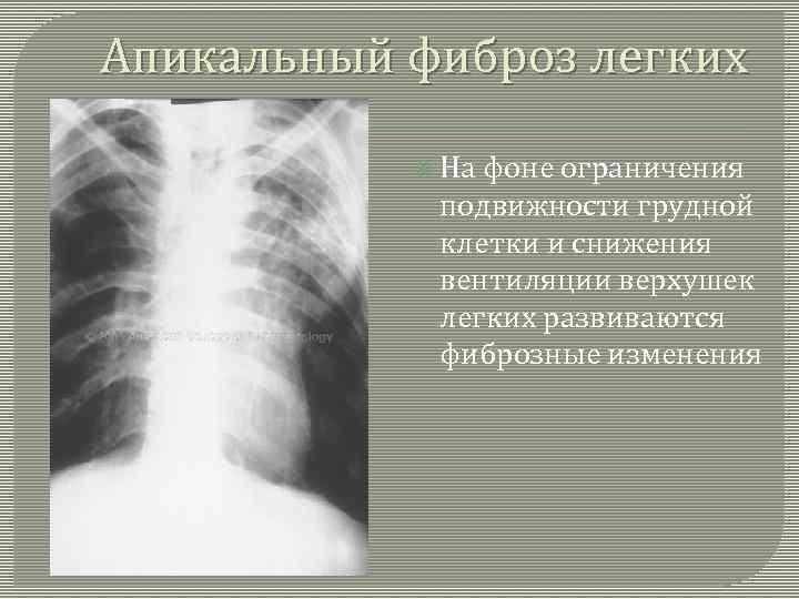 Апикальный фиброз легких На фоне ограничения подвижности грудной клетки и снижения вентиляции верхушек легких