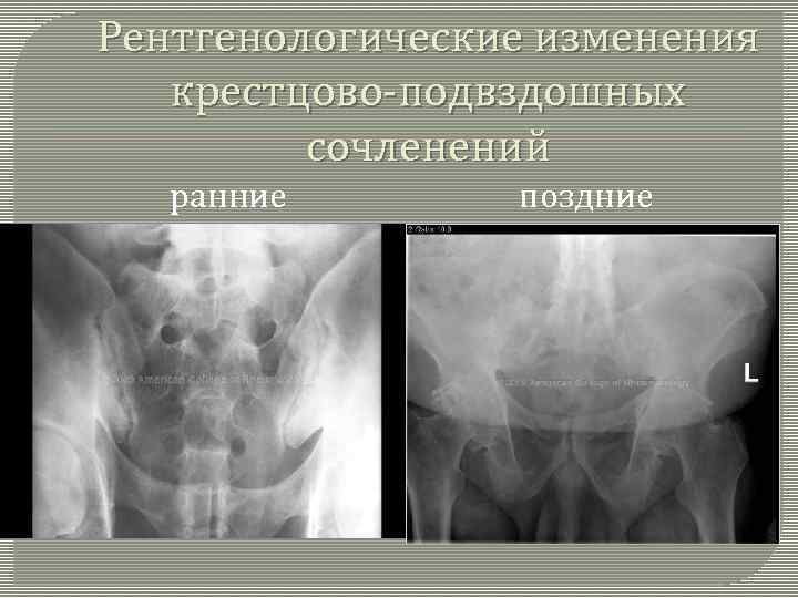 Рентгенологические изменения крестцово-подвздошных сочленений ранние поздние 