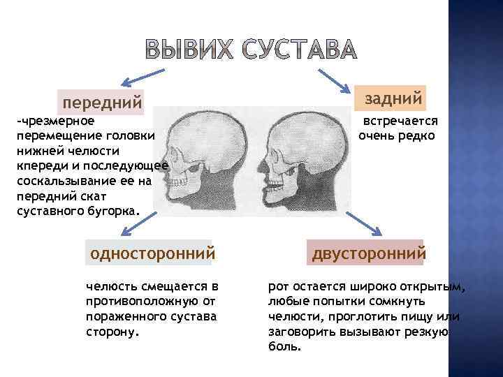 передний -чрезмерное перемещение головки нижней челюсти кпереди и последующее соскальзывание ее на передний скат