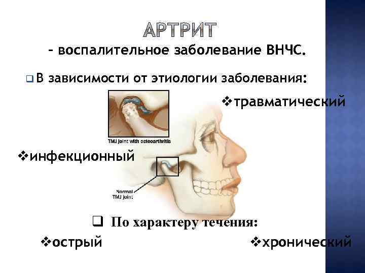 - воспалительное заболевание ВНЧС. q. В зависимости от этиологии заболевания: vтравматический vинфекционный q По