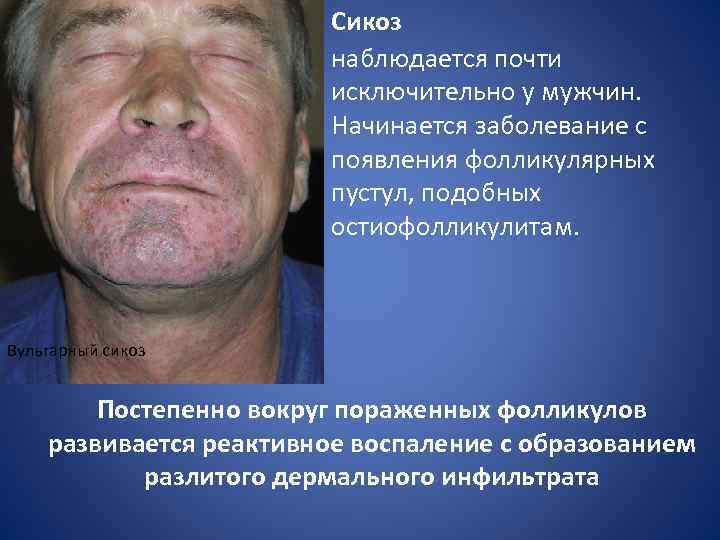 Сикоз наблюдается почти исключительно у мужчин. Начинается заболевание с появления фолликулярных пустул, подобных остиофолликулитам.