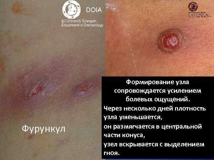 Фурункул Формирование узла сопровождается усилением болевых ощущений. Через несколько дней плотность узла уменьшается, он