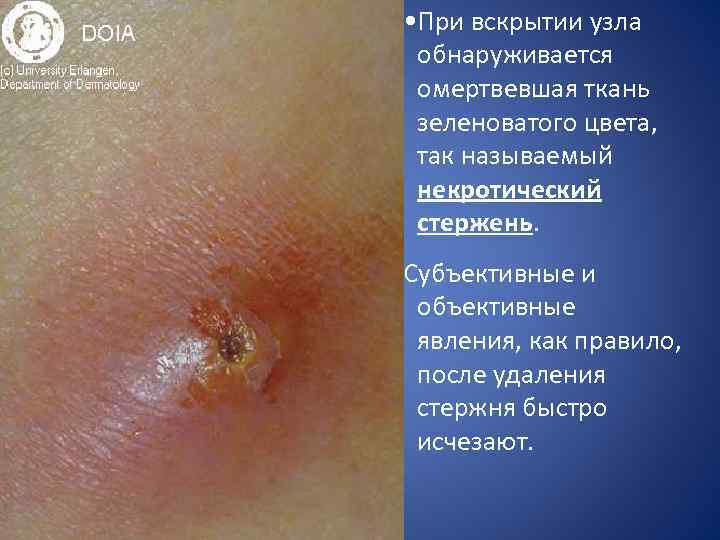  • При вскрытии узла обнаруживается омертвевшая ткань зеленоватого цвета, так называемый некротический стержень.