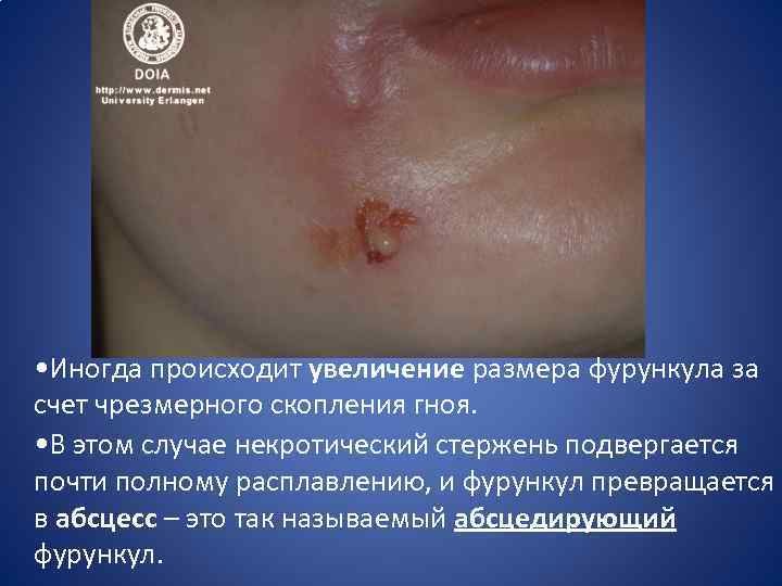  • Иногда происходит увеличение размера фурункула за счет чрезмерного скопления гноя. • В