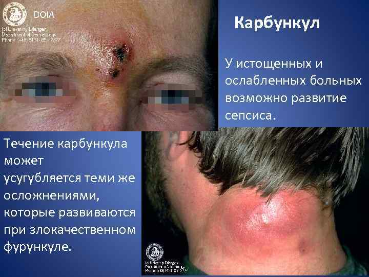 Карбункул У истощенных и ослабленных больных возможно развитие сепсиса. Течение карбункула может усугубляется теми