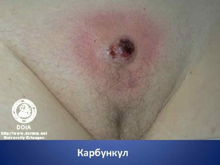Карбункул 