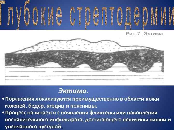  Эктима. • Поражения локализуются преимущественно в области кожи голеней, бедер, ягодиц и поясницы.