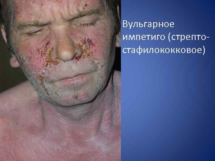 Вульгарное импетиго (стрептостафилококковое) 