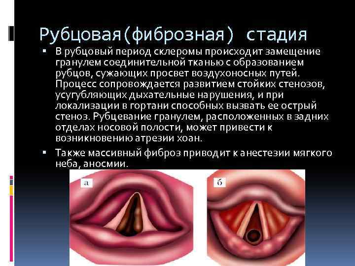 Рубцовая(фиброзная) стадия В рубцовый период склеромы происходит замещение гранулем соединительной тканью с образованием рубцов,