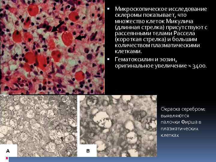  Микроскопическое исследование склеромы показывает, что множество клеток Микулича (длинная стрелка) присутствуют с рассеянными