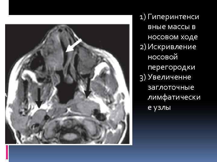 1) Гиперинтенси вные массы в носовом ходе 2) Искривление носовой перегородки 3) Увеличенне заглоточные