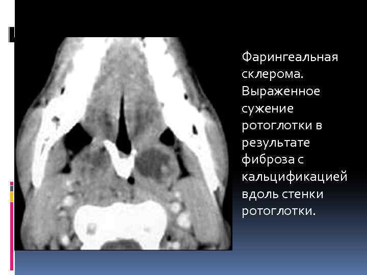 Фарингеальная склерома. Выраженное сужение ротоглотки в результате фиброза с кальцификацией вдоль стенки ротоглотки. 