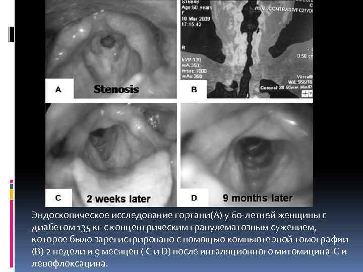 Эндоскопическое исследование гортани(А) у 60 -летней женщины с диабетом 135 кг с концентрическим гранулематозным