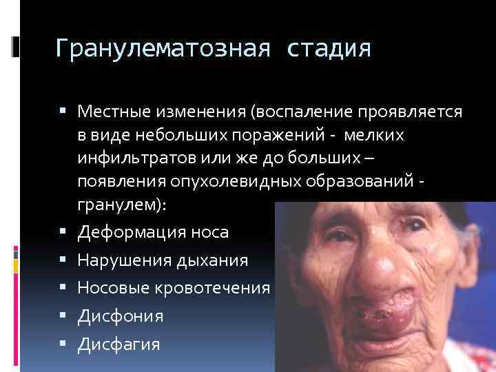 Гранулематозная стадия Местные изменения (воспаление проявляется в виде небольших поражений - мелких инфильтратов или