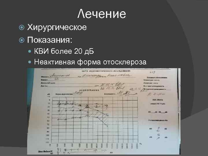 Лечение Хирургическое Показания: КВИ более 20 д. Б Неактивная форма отосклероза 