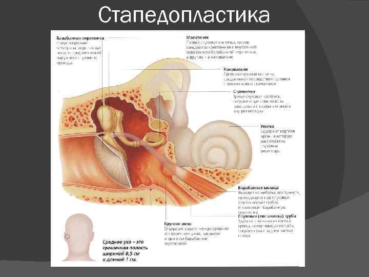 Стапедопластика 