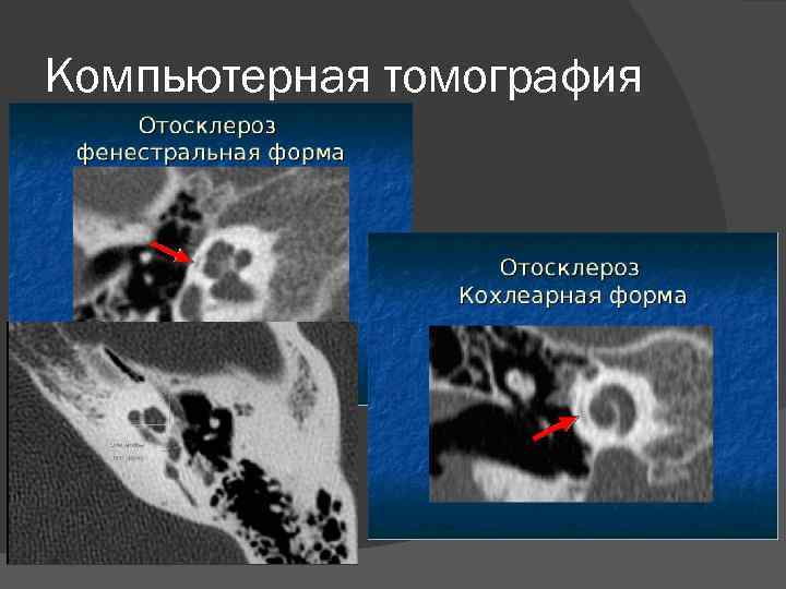 Компьютерная томография 