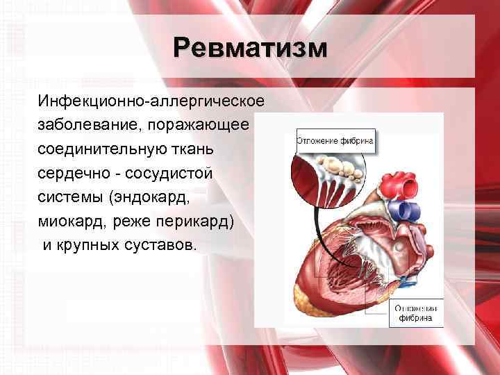 Ревматизм Инфекционно-аллергическое заболевание, поражающее соединительную ткань сердечно - сосудистой системы (эндокард, миокард, реже перикард)