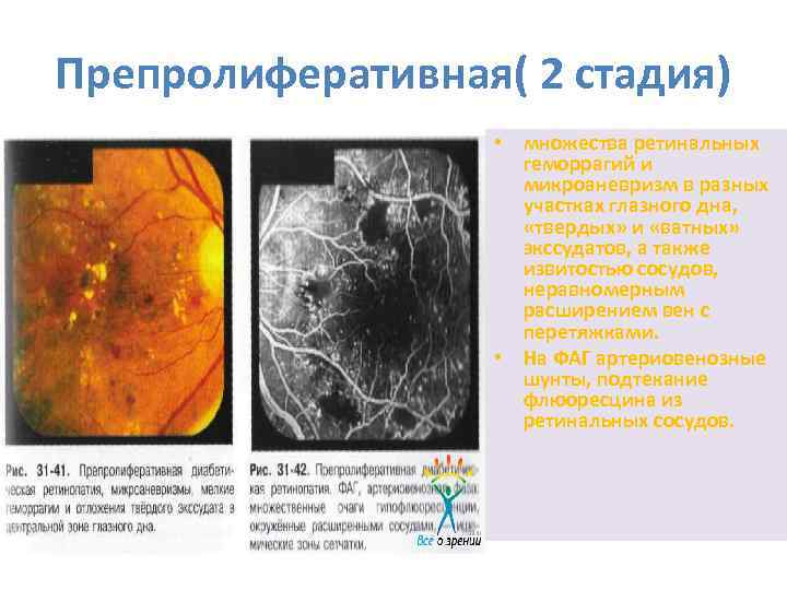 Препролиферативная( 2 стадия) • множества ретинальных геморрагий и микроаневризм в разных участках глазного дна,