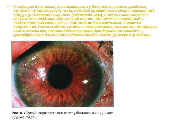  • К ведущим признакам, развивающимся у больных сахарным диабетом, относится синдром сухого глаза,