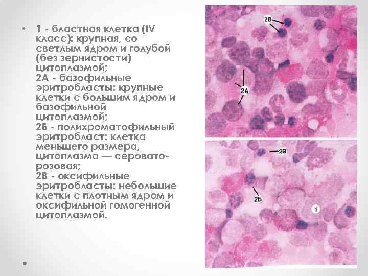  • 1 - бластная клетка (IV класс): крупная, со светлым ядром и голубой