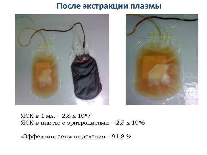 После экстракции плазмы ЯСК в 1 мл. – 2, 8 х 10*7 ЯСК в