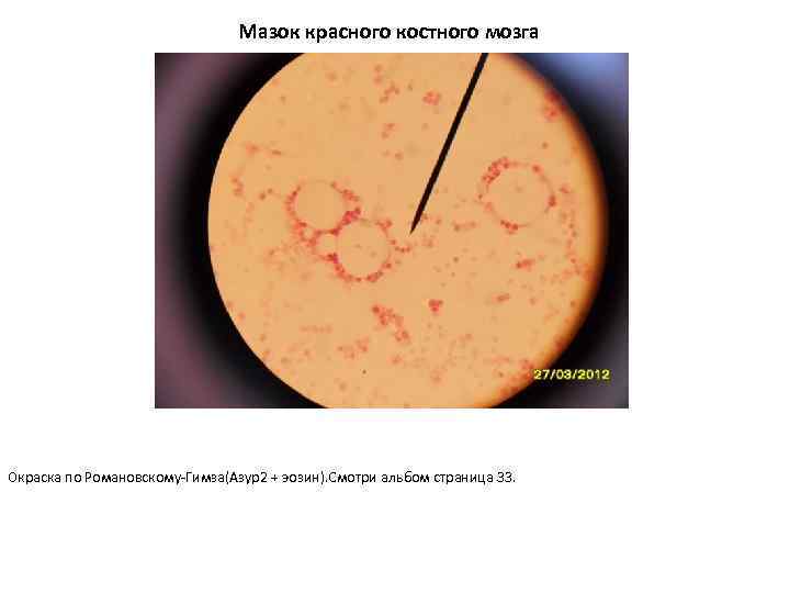 Мазок красного костного мозга Окраска по Романовскому-Гимза(Азур2 + эозин). Смотри альбом страница 33. 