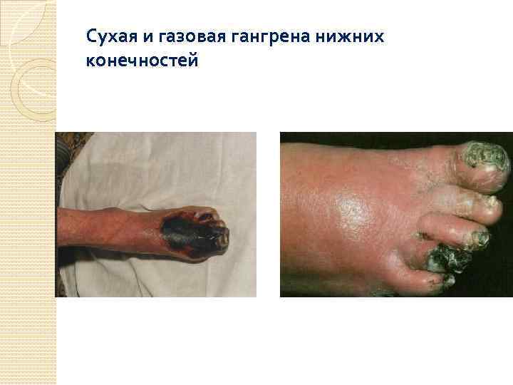 Сухая и газовая гангрена нижних конечностей 