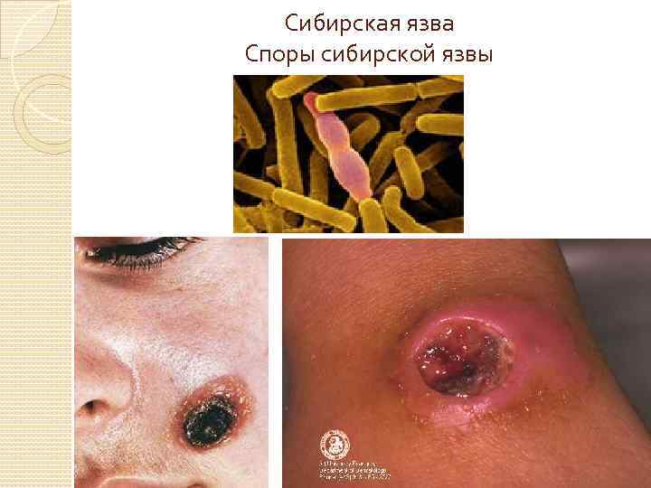Сибирская язва Споры сибирской язвы 