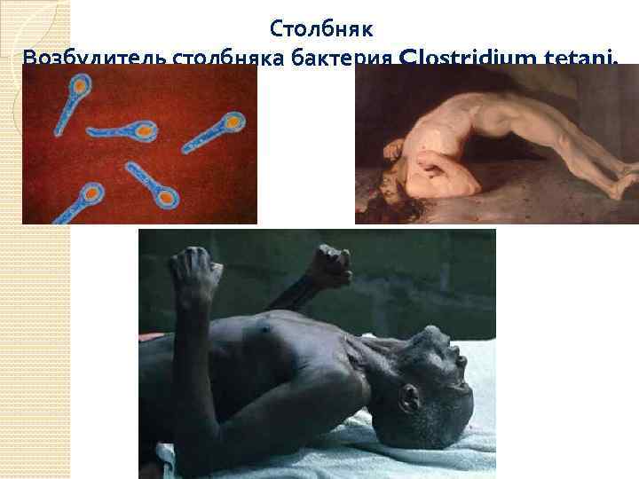 Столбняк Возбудитель столбняка бактерия Clostridium tetani. 