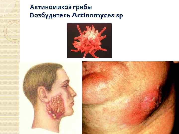 Актиномикоз грибы Возбудитель Actinomyces sp 